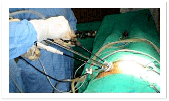 최근에 시행되고 있는단일공법 복강경 수술 장면